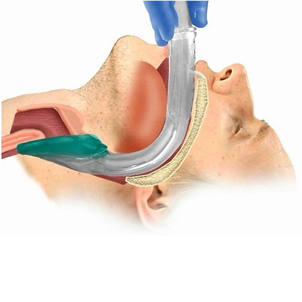 Laryngeal Mask Airway Insertion